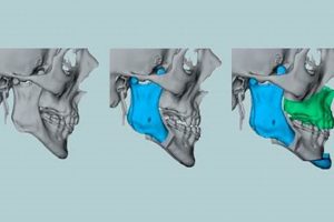 Best MMA Surgery for Sleep Apnea Relief | Ultimate Guide to MMA: Training, Techniques, and Top Fighters in The World