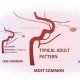 MMA Embolization: Injury Treatment & Recovery | Ultimate Guide to MMA: Training, Techniques, and Top Fighters in The World