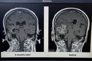 MMA Fighters & Brain Injury Risks Ultimate Guide to MMA: Training, Techniques, and Top Fighters in The World MMA Fighters & Brain Injury Risks | Ultimate Guide to MMA: Training, Techniques, and Top Fighters in The World