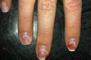 MMA Nail Damage: Why It Happens & How to Prevent It Ultimate Guide to MMA: Training, Techniques, and Top Fighters in The World MMA Nail Damage: Why It Happens & How to Prevent It | Ultimate Guide to MMA: Training, Techniques, and Top Fighters in The World
