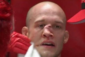 MMA Broken Nose: Causes, Treatment & Recovery Ultimate Guide to MMA: Training, Techniques, and Top Fighters in The World MMA Broken Nose: Causes, Treatment & Recovery | Ultimate Guide to MMA: Training, Techniques, and Top Fighters in The World
