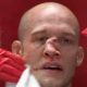 MMA Broken Nose: Causes, Treatment & Recovery | Ultimate Guide to MMA: Training, Techniques, and Top Fighters in The World