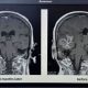 MMA Brain Damage: Risks, Symptoms & Prevention | Ultimate Guide to MMA: Training, Techniques, and Top Fighters in The World