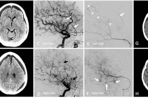 Bilateral MMA Embolization: A Complete Guide Ultimate Guide to MMA: Training, Techniques, and Top Fighters in The World Bilateral MMA Embolization: A Complete Guide | Ultimate Guide to MMA: Training, Techniques, and Top Fighters in The World