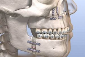 The Ultimate Guide to MMA Surgery & Recovery Ultimate Guide to MMA: Training, Techniques, and Top Fighters in The World The Ultimate Guide to MMA Surgery & Recovery | Ultimate Guide to MMA: Training, Techniques, and Top Fighters in The World