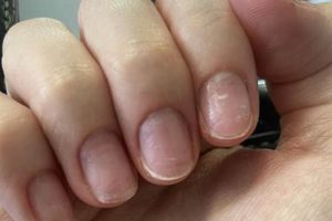 MMA Damaged Nails: Causes, Prevention & Treatment | Ultimate Guide to MMA: Training, Techniques, and Top Fighters in The World