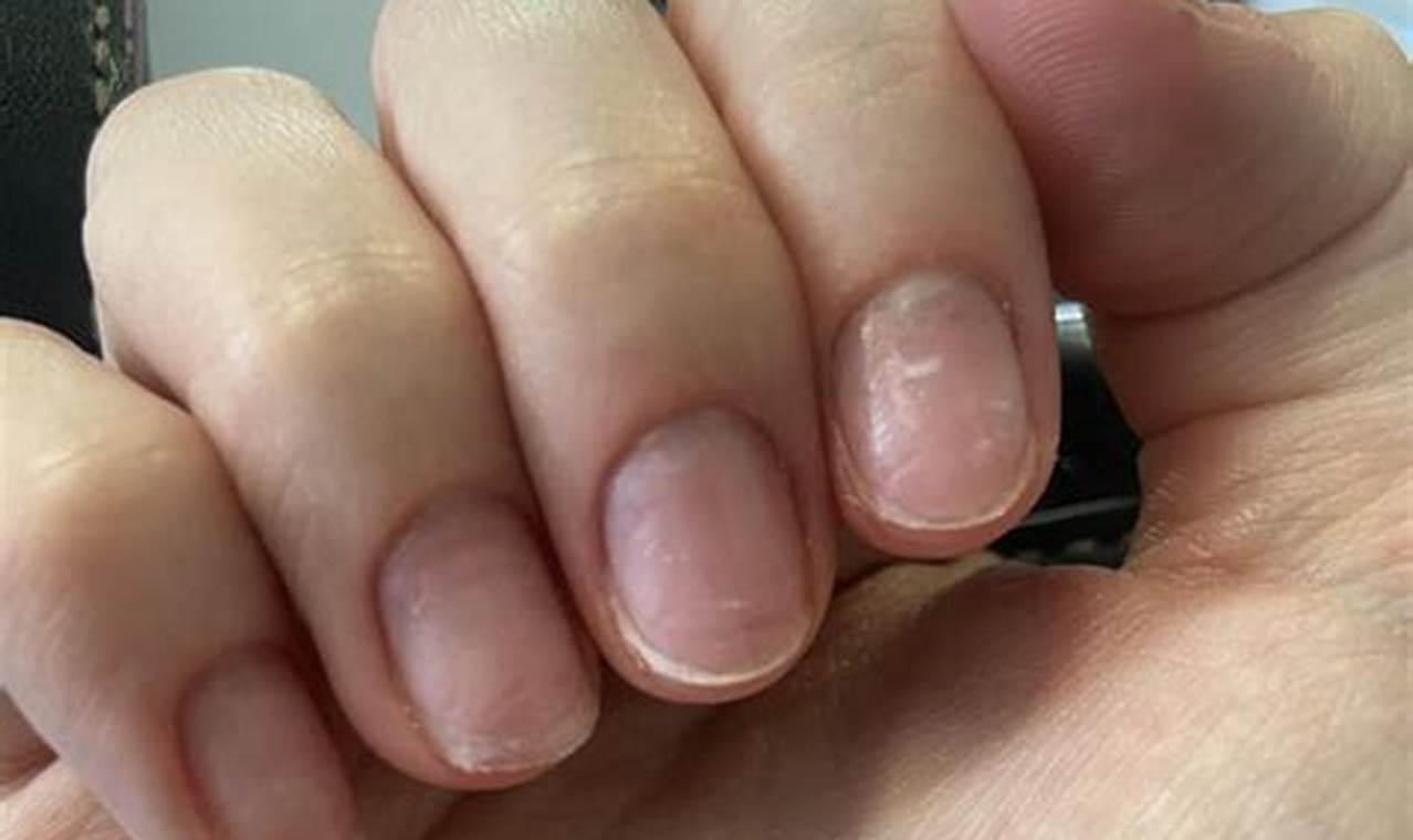 MMA Damaged Nails: Causes, Prevention & Treatment | Ultimate Guide to MMA: Training, Techniques, and Top Fighters in The World