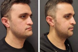 MMA Surgery Cost: A Fighter's Guide Ultimate Guide to MMA: Training, Techniques, and Top Fighters in The World MMA Surgery Cost: A Fighter's Guide | Ultimate Guide to MMA: Training, Techniques, and Top Fighters in The World