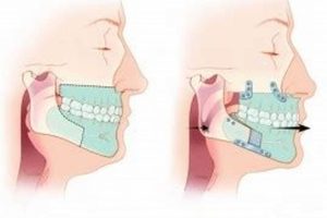 Best MMA Surgery for Sleep Apnea: A Guide | Ultimate Guide to MMA: Training, Techniques, and Top Fighters in The World