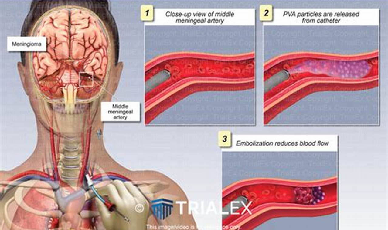 MMA Embolization CPT Codes & Billing Guide | Ultimate Guide to MMA: Training, Techniques, and Top Fighters in The World